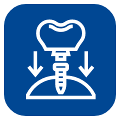 Trồng Răng Implant