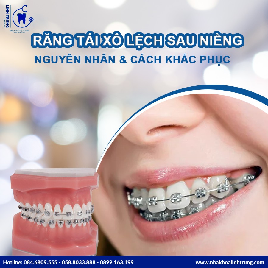 Niềng răng thẩm mỹ